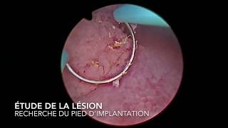 chirurgie endoscopique  résection de polype de vessie par voie transurétral [upl. by Doig]