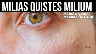 MILIAS EN LA CARA I QUISTES MILIUM I FACE WHITE HEADS I MILIAS TREATMENTS [upl. by Raseac]