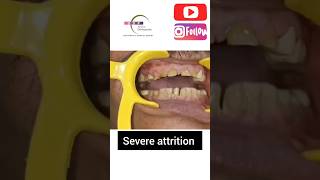 Management of severe attrition With Capping of teeth [upl. by Quin]