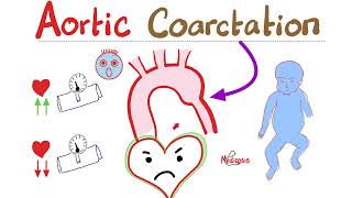 Coarctation of the Aorta  Cardiology Series  Types Symptoms Signs Diagnosis amp Treatment [upl. by Alexandre220]