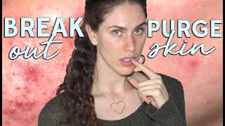 Skin Purge VS Breakouts  How To Tell If Youre Having A Product Reaction [upl. by Ennaharas]