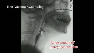 Swallowing with nonvacuum and vacuum [upl. by Aicelet]