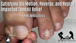 How to Clean Impacted Toenail Satisfying Pedicure Tutorial [upl. by Melania]