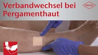 Schmerzfreier Verbandwechsel bei Pergamenthaut  Wundauflagen mit SilikonHaftrand [upl. by Fatma]