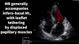 Inferior wall myocardial infarction [upl. by Airdnaxela]