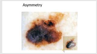 melanocytic lesions dermoscopy 2 dr yasmina el attar [upl. by Etiuqram431]