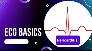 ECG Basics  ECG Changes in Pericarditis  Benign Early Repolarization Vs Pericarditis [upl. by Aynwad]