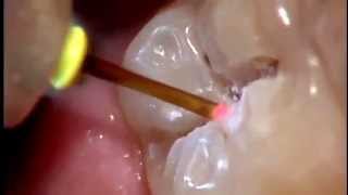 Tratamiento de caries sin dolor y sin anestesia Láser dental [upl. by Runkel]