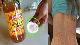 tinea versicolor treatment  how to get rid of tinea versicolor natural treatment [upl. by Hannaoj]