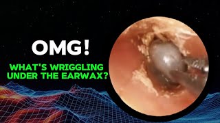 Horrifying  Insects combine with earwax to block the ear canal [upl. by Okorih]