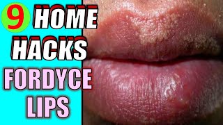 How to Get Rid of Fordyce Spots at Home Quickly  9 Home Remedies for Fordyce Spots on Lips [upl. by Lenny574]