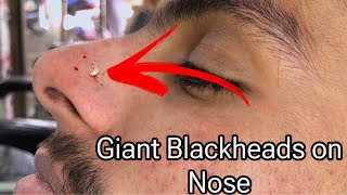 Blackheads on Nose  Giant Blackheads on Nose ​⁠ ​Popping Blackheads [upl. by Aloke]