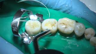 OPERATORIA DENTAL Y ENDODONCIA TÉCNICAS Y MATERIALES7 COMPOSITE CAVIDAD DE CLASE I [upl. by Elvis]