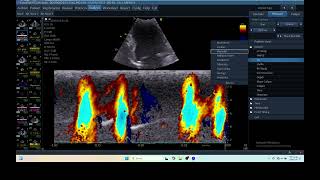 IQ 213 Vp COLOR M MODE ECHOCARDIOGRAPHY HEMODYNAMIC MEASUREMENT 2 [upl. by Deeyn]