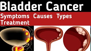 Bladder Cancer Types What causes bladder cancer Bladder Cancer Symptoms Bladder Cancer Treatment [upl. by Pate504]