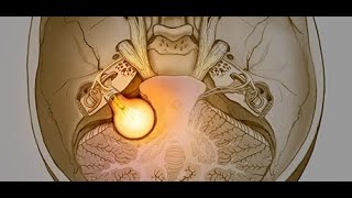 vestibular schwannoma pre and post operative [upl. by Isdnil287]