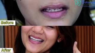 Transforming Smiles Veneer Treatment for Megha Dassani by Dr Amit Nandi MDS  Botanikx Kolkata [upl. by Yrnehnhoj]