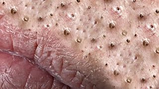 Big Cystic Acne Blackheads Extraction Blackheads amp Milia Whiteheads Removal Pimple Popping  5378 [upl. by Pergrim]