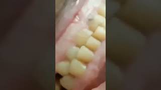 What does BRUXISM or Teeth Grinding sound like [upl. by Jammal]