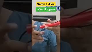 Seton placement for treatment of High Lying Fistula drimtiazhussain generalsurgery [upl. by Yoreel68]