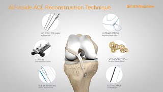 Allinside ACL Reconstruction Animation [upl. by Tella506]