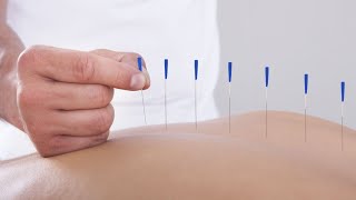 Harnessing the Power of Acupuncture Therapy [upl. by Adikram]