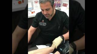 Laser Genesis amp Excel V laser treatment performed by Dr P Alexander Ataii at Laser Clinique [upl. by Eedyaj]