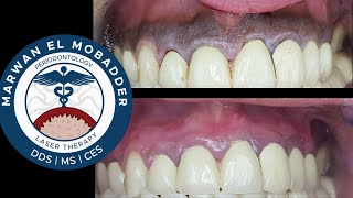 Tips for a Successful Gingival Depigmentation [upl. by Eihtur]