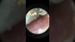 Clean earwax in the ear earwax earwaxremoval earwaxremmoval earwaxcleaning satisfying rela [upl. by Merralee]