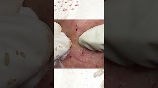 Big Cystic Acne Blackheads Extraction Blackheads amp Milia Whiteheads Removal Pimple Popping [upl. by Htebasile]