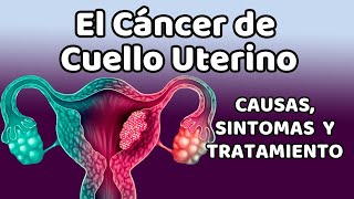 CÁNCER DE CUELLO UTERINO Causas signos y síntomas diagnóstico y tratamiento [upl. by Aicenra]