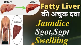 Homeopathic medicine for fatty liver  Liver inflammation Sgotsgpt jaundice cirrhosis Treatment [upl. by Warrick]