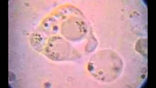 T hominis con 5 Blastocystis fagocitados intento de fagocitosis de otro y expulsión de uno [upl. by Wellington]