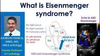 What is Eisenmenger syndrome [upl. by Ezequiel964]