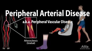 Peripheral artery disease Pathophysiology Causes Symptoms Diagnosis and Treatments Animation [upl. by Soinski]