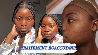 BILAN 1 AN APRÈS TRAITEMENT ROACCUTANECURACNÉACCUTANE TREATMENT PEAU NOIREDARK SKIN [upl. by Ennoirb]