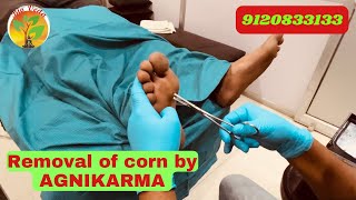 Painful Corn removal by AGNIKARMA agnikarma drsanjeevsingh ayodhya viral panchkarma [upl. by Auerbach494]