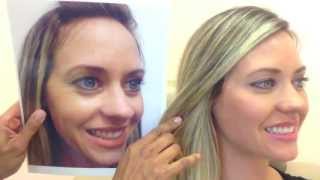 Botox amp Restylane Before amp After [upl. by Eirek]