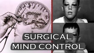 The Most BRUTAL Surgical Procedure  The Lobotomy  Dark History Documentary [upl. by Jocko]