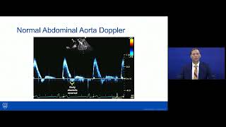 Coarctation of the AortaImaging and Management [upl. by Zined]