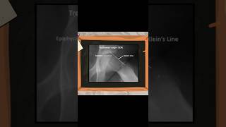 What is Trethowans Sign in SCFE  limp limping ortholectures orthopaedics orthodoc ortho [upl. by Lotsyrk387]