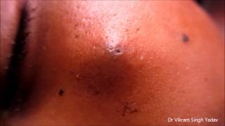 Big Infected Sebaceous Cyst Face [upl. by Terry192]