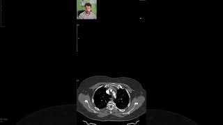 PAIN and MISSING PULSE in the left arm  CT SCANS Ep 15 ctscan medicalimaging angiography [upl. by Cherian]