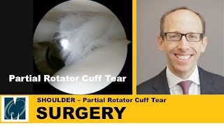 Shoulder Pain  Partial Rotator Cuff Tears [upl. by Pope858]