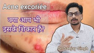 Acne excoriée  चेहरे पर pimples  क्या आप भी इसके शिकार हैं Acne Pigmentation face acnetreatment [upl. by Arlene]