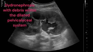 RIGHT PYELONEPHRITIS WITH PYONEPHROSIS [upl. by Gaultiero758]