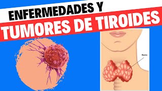 Tumores y enfermedades de tiroides Todo lo que necesitas saber [upl. by Tedmund]