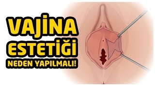 Vajina Estetiği Ameliyatları Neden Yaptırılmalı 18 [upl. by Namrac781]