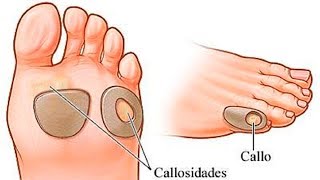 ✔ Como Quitar Callos de los Pies con este POTENTE REMEDIO de 2 Ingredientes [upl. by Tawsha]