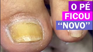 Alta de hipercurvatura Renata Werneck Podóloga  Unha Encravada REMOVE INGROWN NAIL [upl. by Ahsirat683]